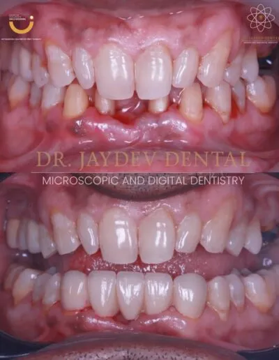 Before-after-Premium-grade-prosthesis 1