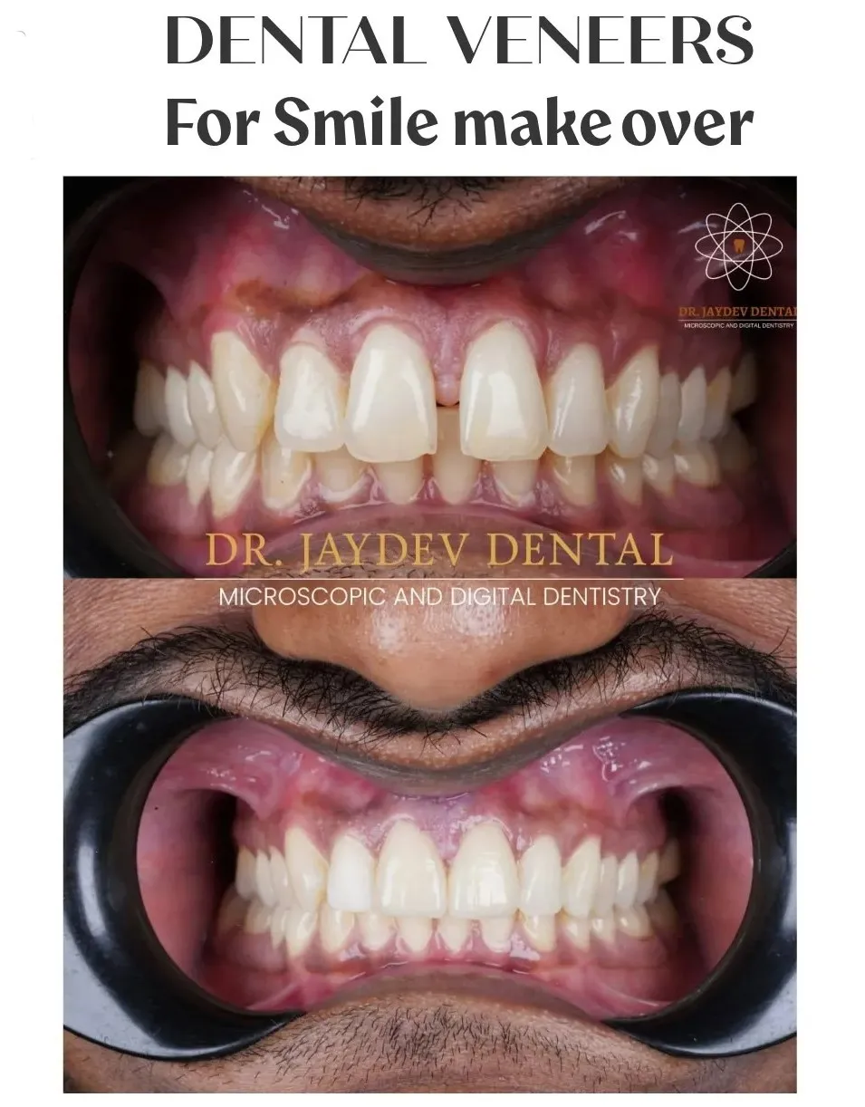 Dental-veneers-before-after