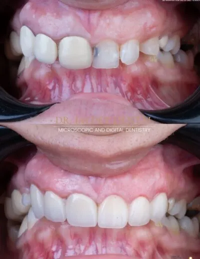 before-after-dental-treatment
