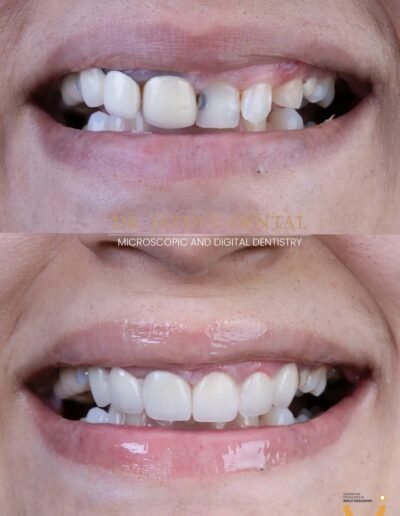 smile-image-before-after-treatment