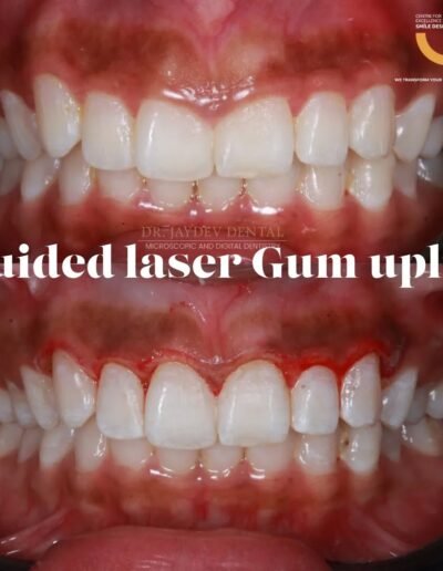 Guided-laser-gum-uplift