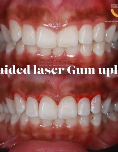 Guided-laser-gum-uplift
