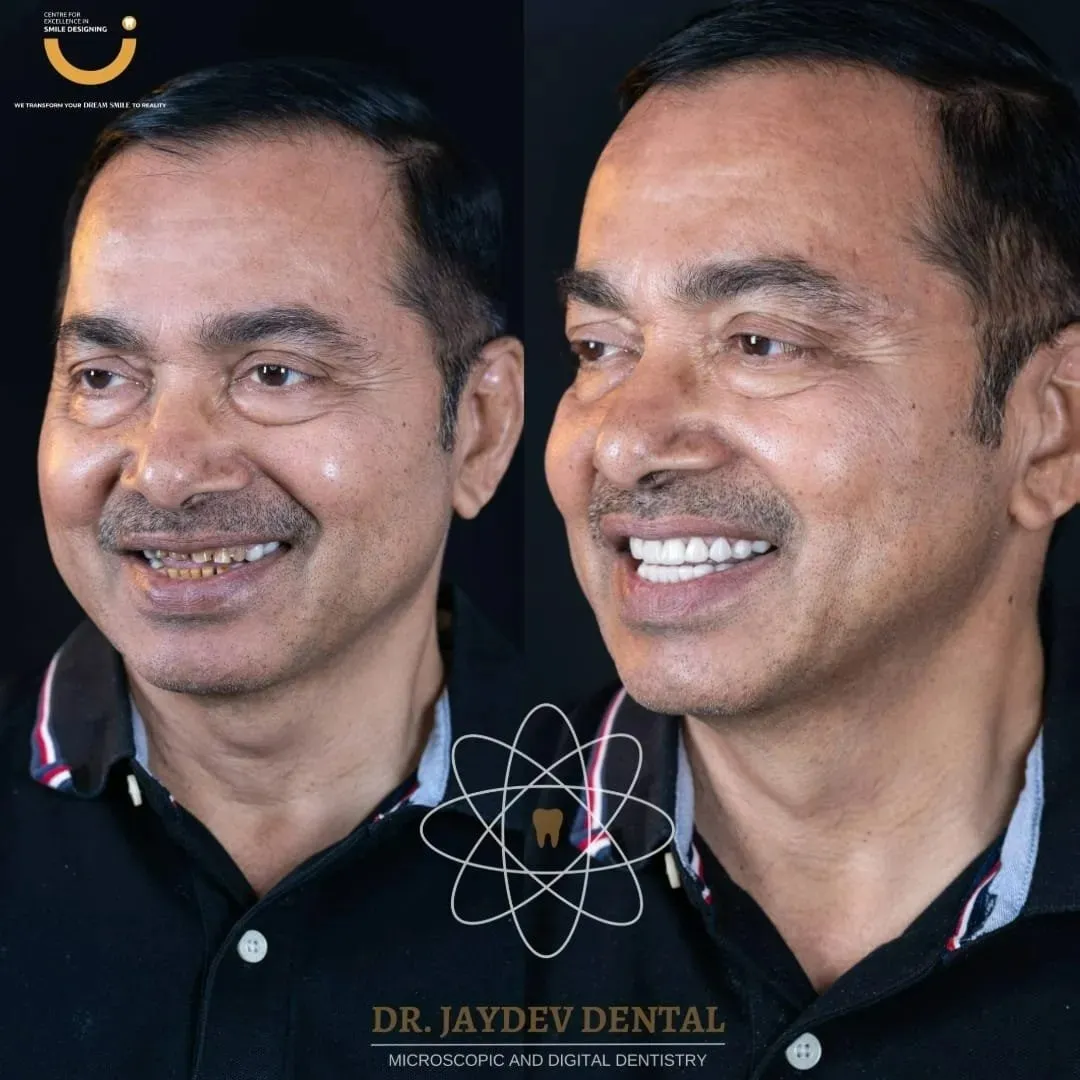 Smile-makeover-of-an-aged-person