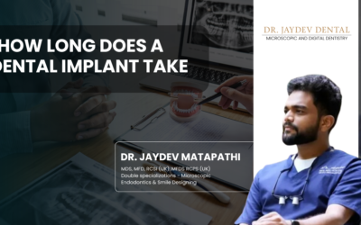 How Long Does a Dental Implant Take|