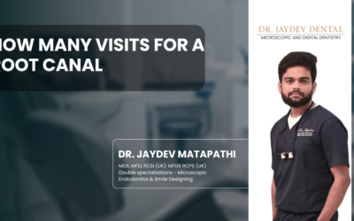 How Many Visits for a Root Canal