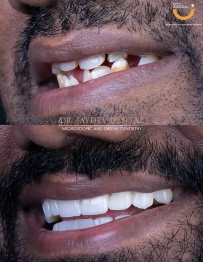 before-afte-result-smile-designing