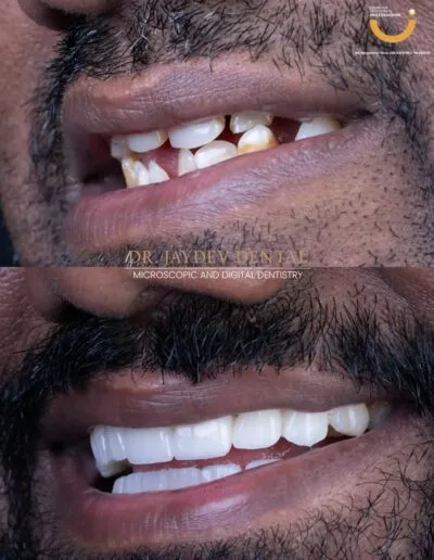 before-afte-result-smile-designing
