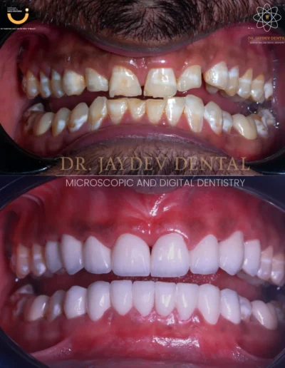 before-after-Proportions-of-Teeth 1