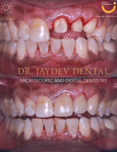 before-after-premium-prosthesis