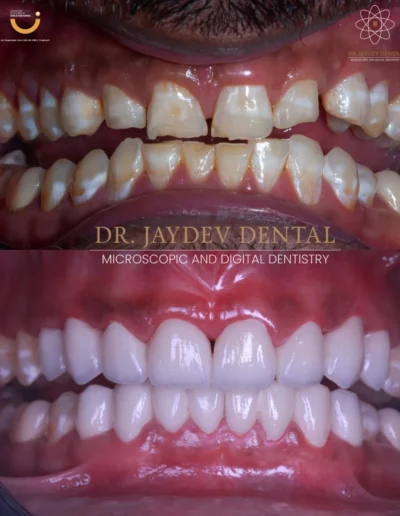 before-after-results-proportions-of-Teeth