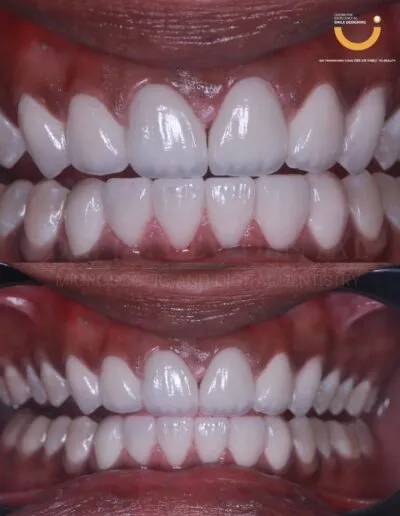 before-and-after-dental-treatment