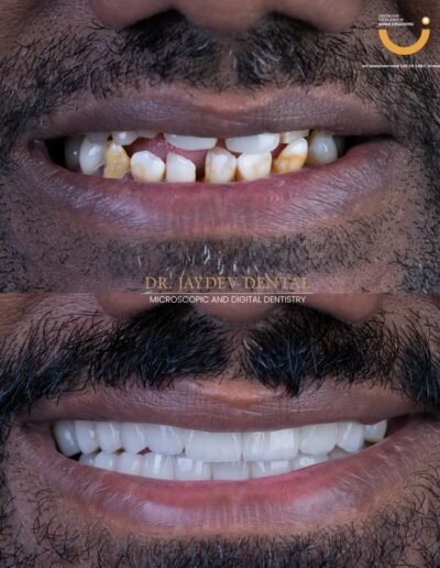 smile-designing-before-after