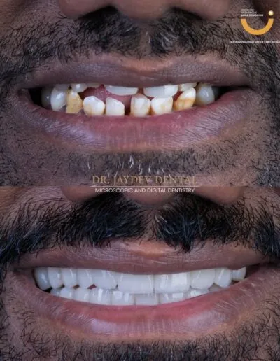smile-designing-before-after