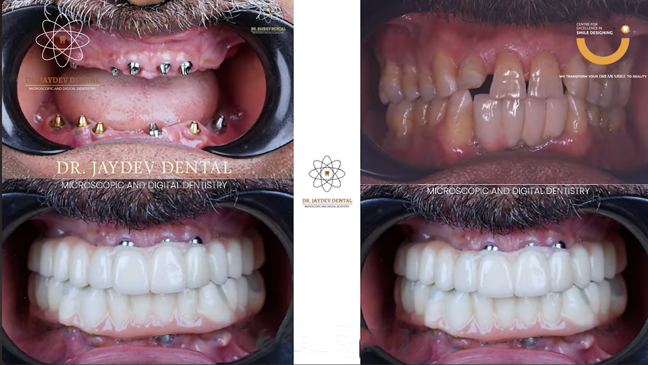 Before-after-image-Dr-Jaydev-Dental