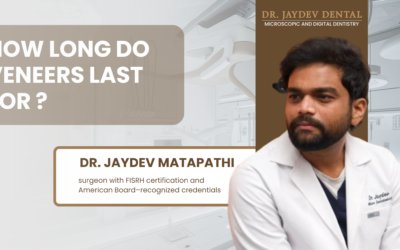 How Long Do Veneers Last For ?