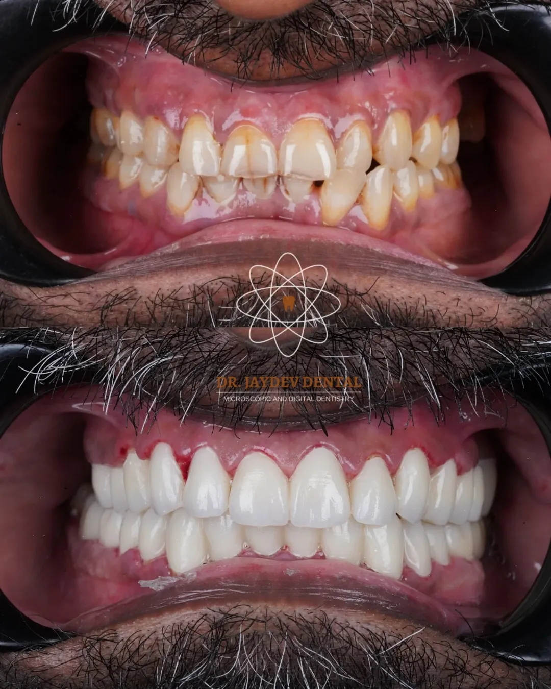 Smile-transformation-dr-jaydev-dental
