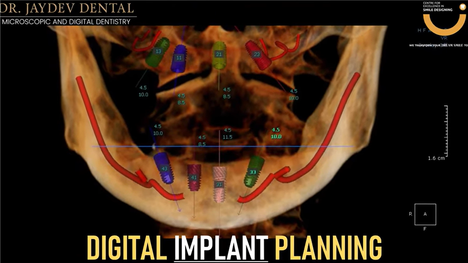 Diigital-implant-planning