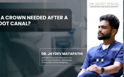 Is a Crown Needed After a Root Canal?