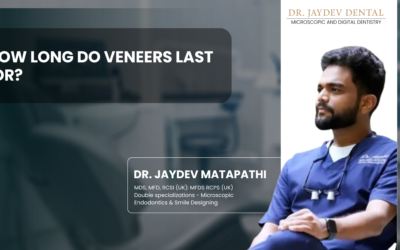 How Long Do Veneers Last For ?