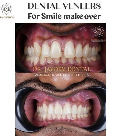 dental-veneers-before-after-image-dr-jaydev-dental