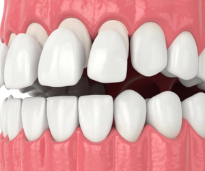 Close-up illustration of upper and lower teeth with front teeth not meeting, showing a bite misalignment on a dental model.