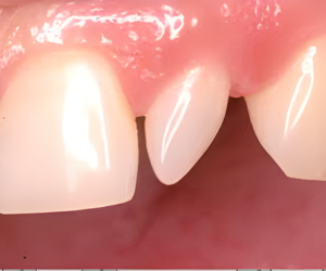 Close-up of upper front teeth showing a chipped edge between the central and lateral incisors.