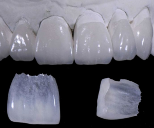 Close-up of upper front teeth with two broken porcelain veneer pieces below on a dark background.