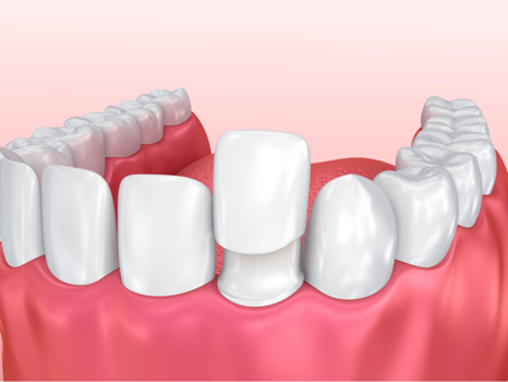 3D dental illustration of an upper jaw showing a crown fitted on a front tooth in a dental arch.