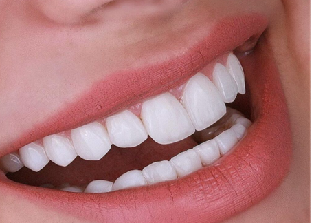 Close-up of a smiling mouth with white teeth and pink lips, with lips slightly parted.