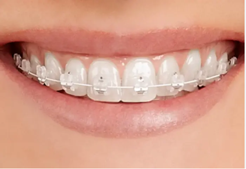 Close-up of a smile with clear ceramic braces on the upper teeth.