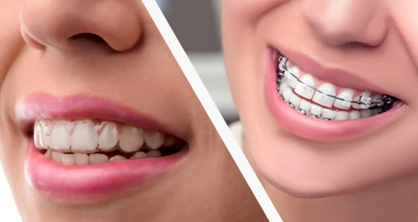 Smiling close-up split image: left shows teeth with clear aligners, right shows teeth with braces (orthodontic treatment)