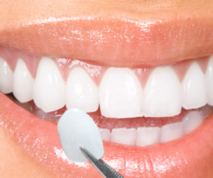 Close-up of a smile during a whitening procedure; a dental tool is applied to a tooth.