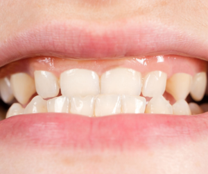 Close-up of a mouth showing crowded, misaligned upper and lower teeth before orthodontic treatment