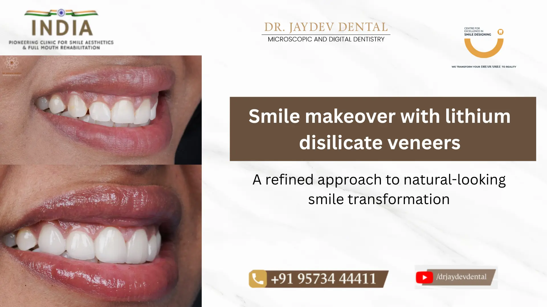 Banner showing before/after smile veneers with text 'Smile makeover with lithium disilicate veneers' and contact info for a dental clinic.