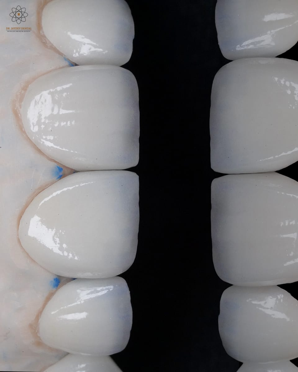 Close-up of two dental arches facing each other, showcasing glossy white teeth on a black background.