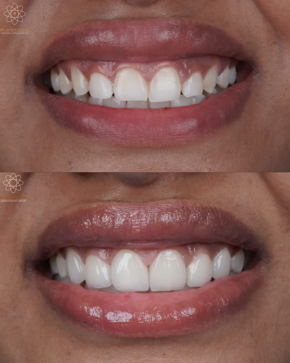 Two-panel close-up of a smile: top image shows darker, stained teeth before whitening; bottom image shows brighter, whiter teeth after whitening (lip gloss visible).