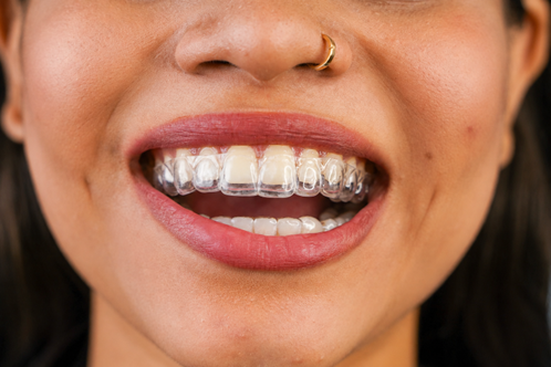 Close-up of a smiling mouth wearing clear aligners on the upper teeth.