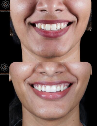 Side-by-side close-up of a woman's smile; top shows before teeth, bottom shows after whitening with brighter, whiter teeth.