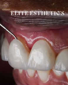 Picture2 | Jaydev Dental Close-up of lower front teeth and gums with a dental instrument probing the gum during a dental exam; watermark reads 'Elite Esthetics'.