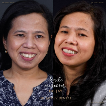 Two women smiling for a dental clinic promotional banner, shown side by side with bright smiles.