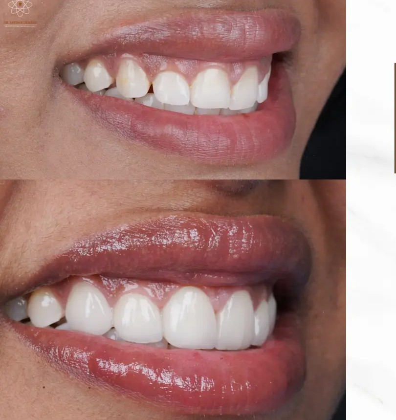 Close-up of a smiling mouth showing a before-and-after whitening comparison: left with yellowed teeth, right with bright white teeth.