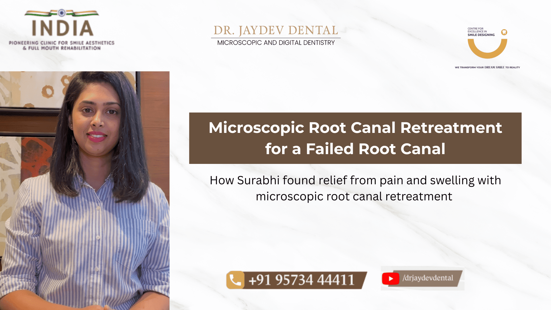 a 1 | Jaydev Dental Portrait of a woman in a striped shirt on the left, with a marble-clay banner and the title 'Microscopic Root Canal Retreat for a Failed Root Canal' on the right.