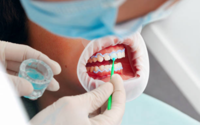 Dental hygienist wearing gloves and a mask applies treatment to a patient’s braces with a small applicator.