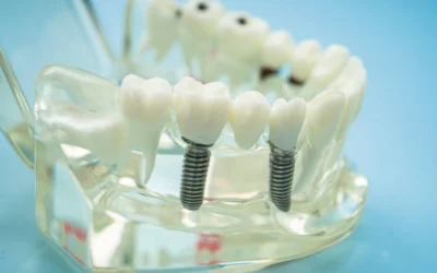 Dental implant model showing two titanium implants with crown abutments on a clear acrylic base against a blue background.