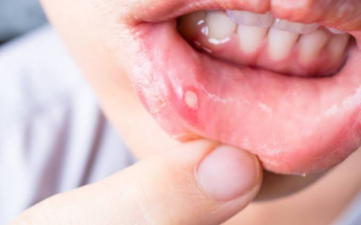 How Stress Shows Up in Your Mouth: Teeth Grinding, TMJ & Canker Sores