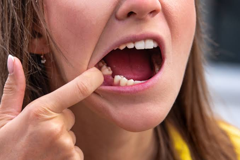 Picture3 | Jaydev Dental Dental Gaps Four Common Causes