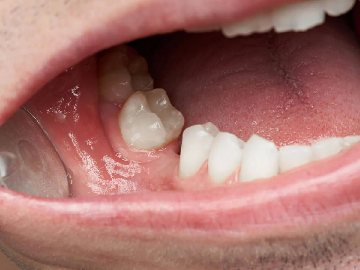 Close-up of a lower jaw showing a partially erupted molar tucked behind the preceding teeth with pink gums nearby (oralview).
