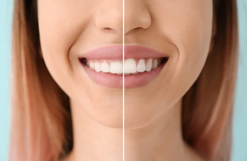 Before-and-after split-screen of a woman's smile; left side stained teeth, right side whiter teeth after whitening.